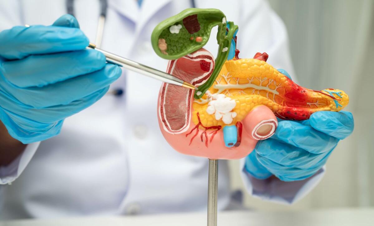 come si formano i calcoli alla colecisti