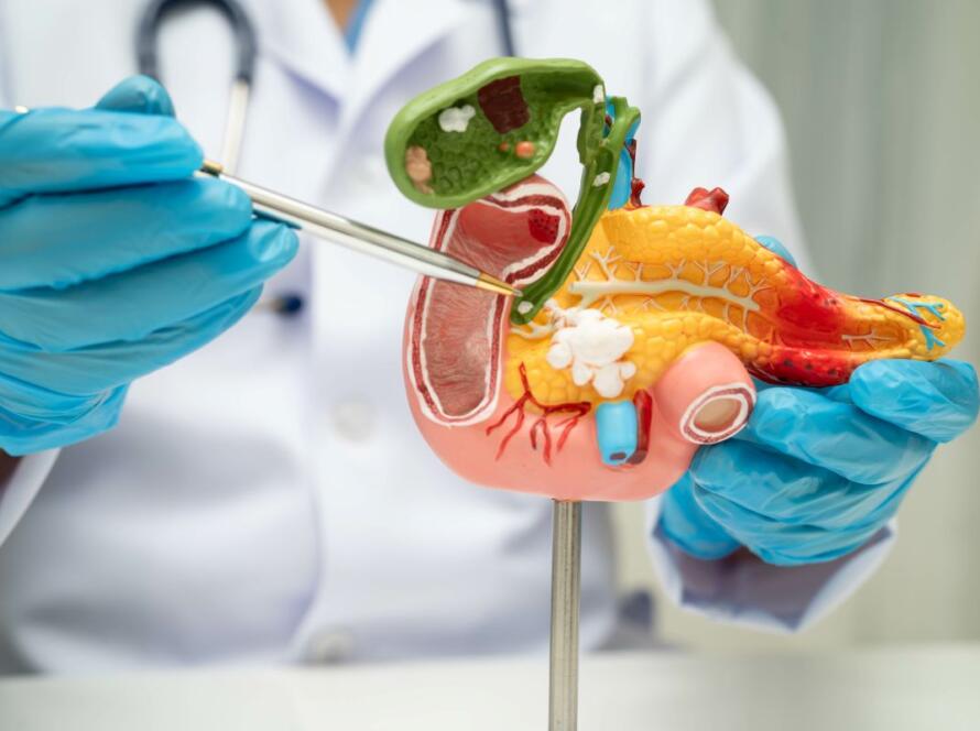 come si formano i calcoli alla colecisti