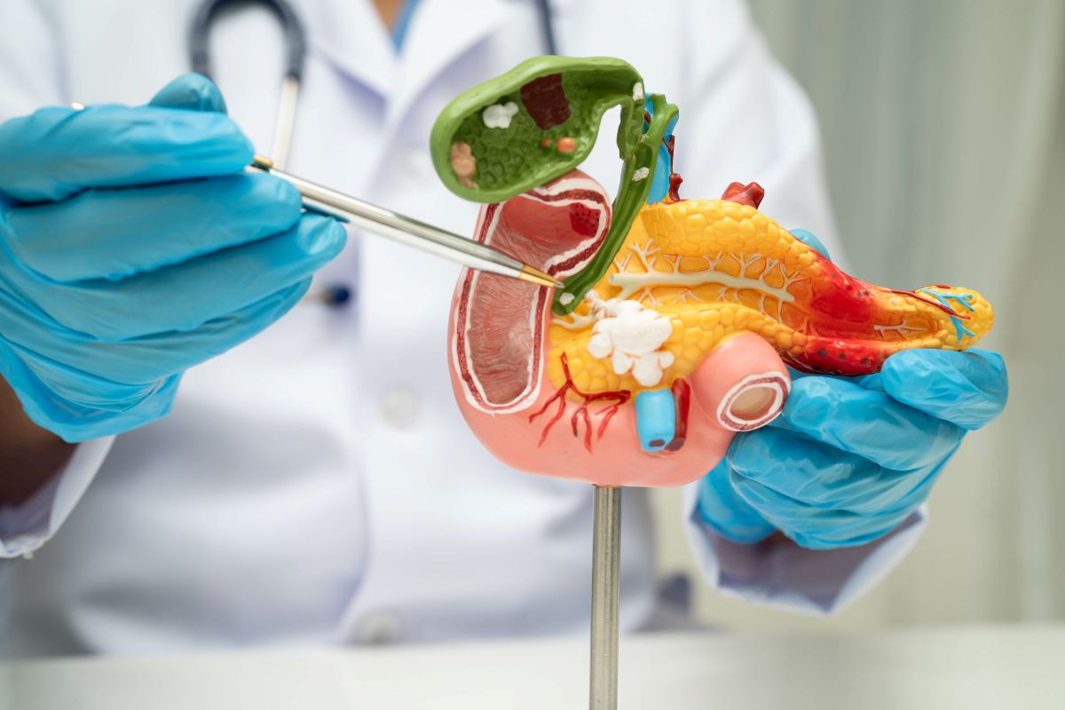 come si formano i calcoli alla colecisti