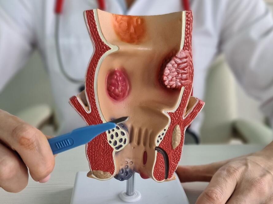 prolasso rettale o emorroidi