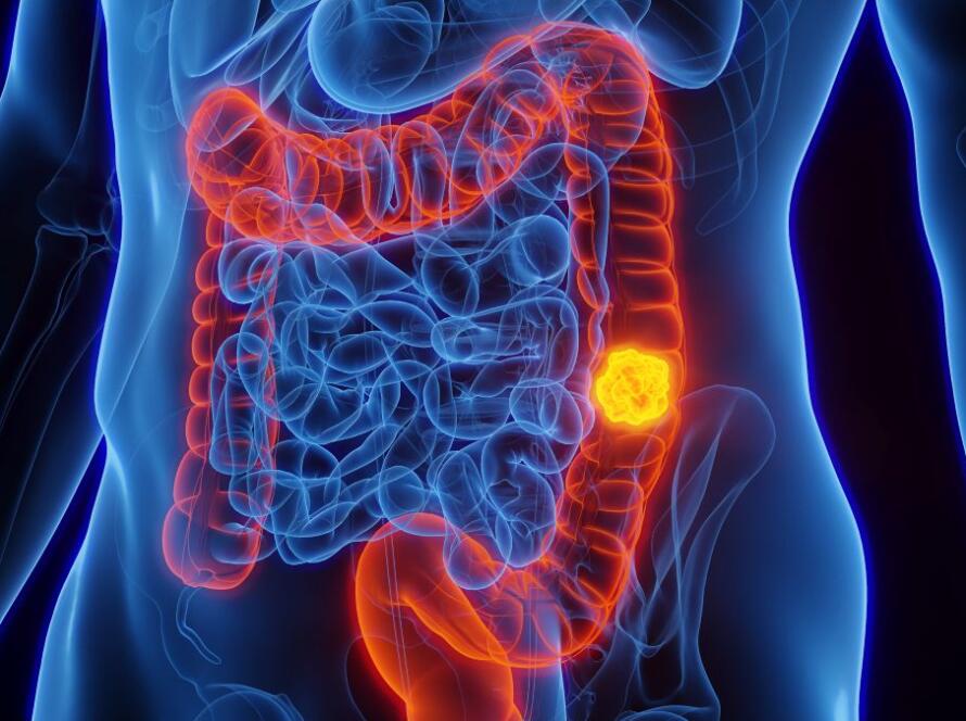 come si manifesta il tumore al colon