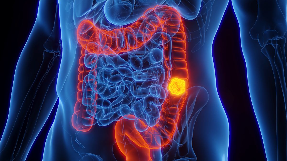 come si manifesta il tumore al colon