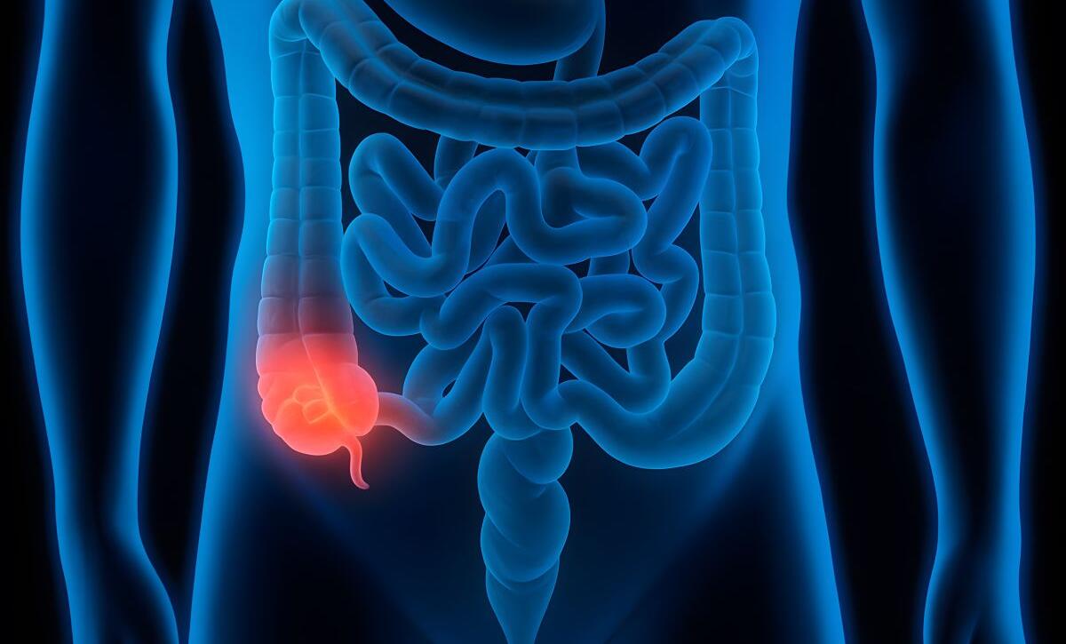 intervento di appendicectomia