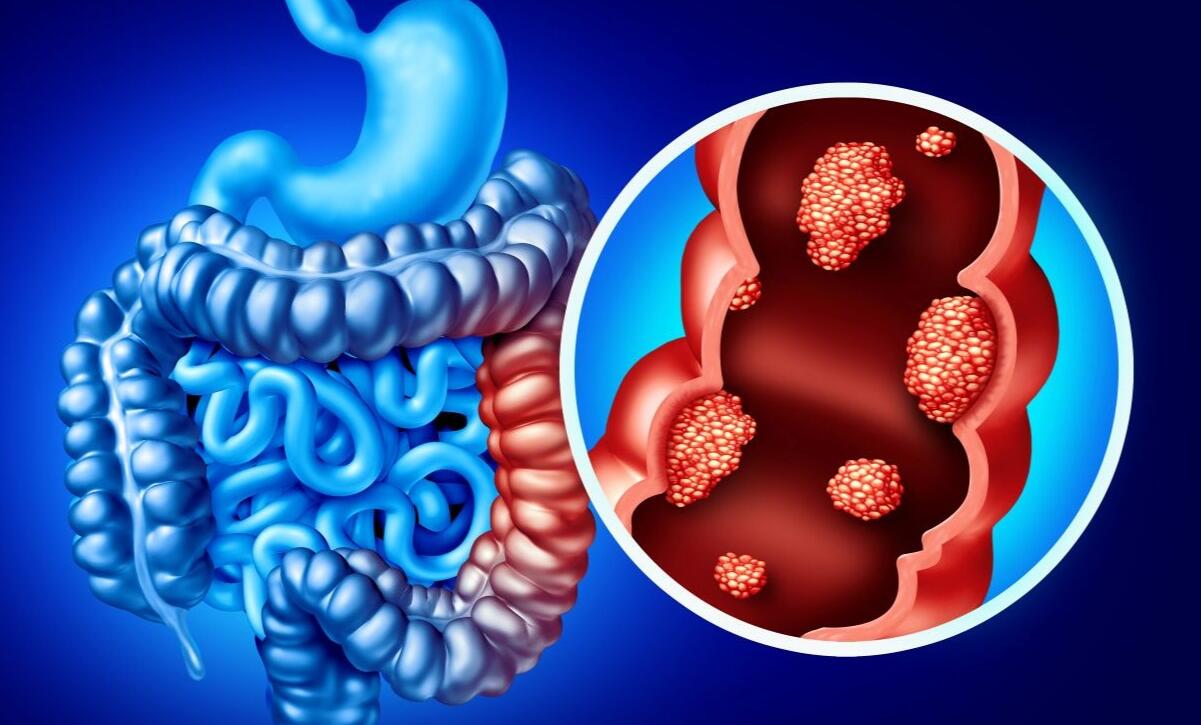 polipi del colon retto sintomi