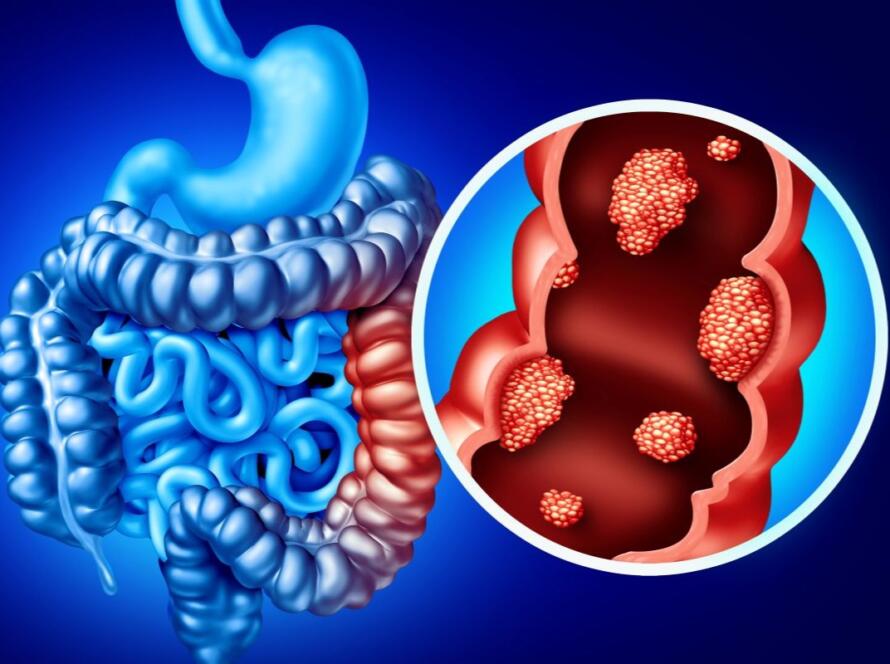 polipi del colon retto sintomi