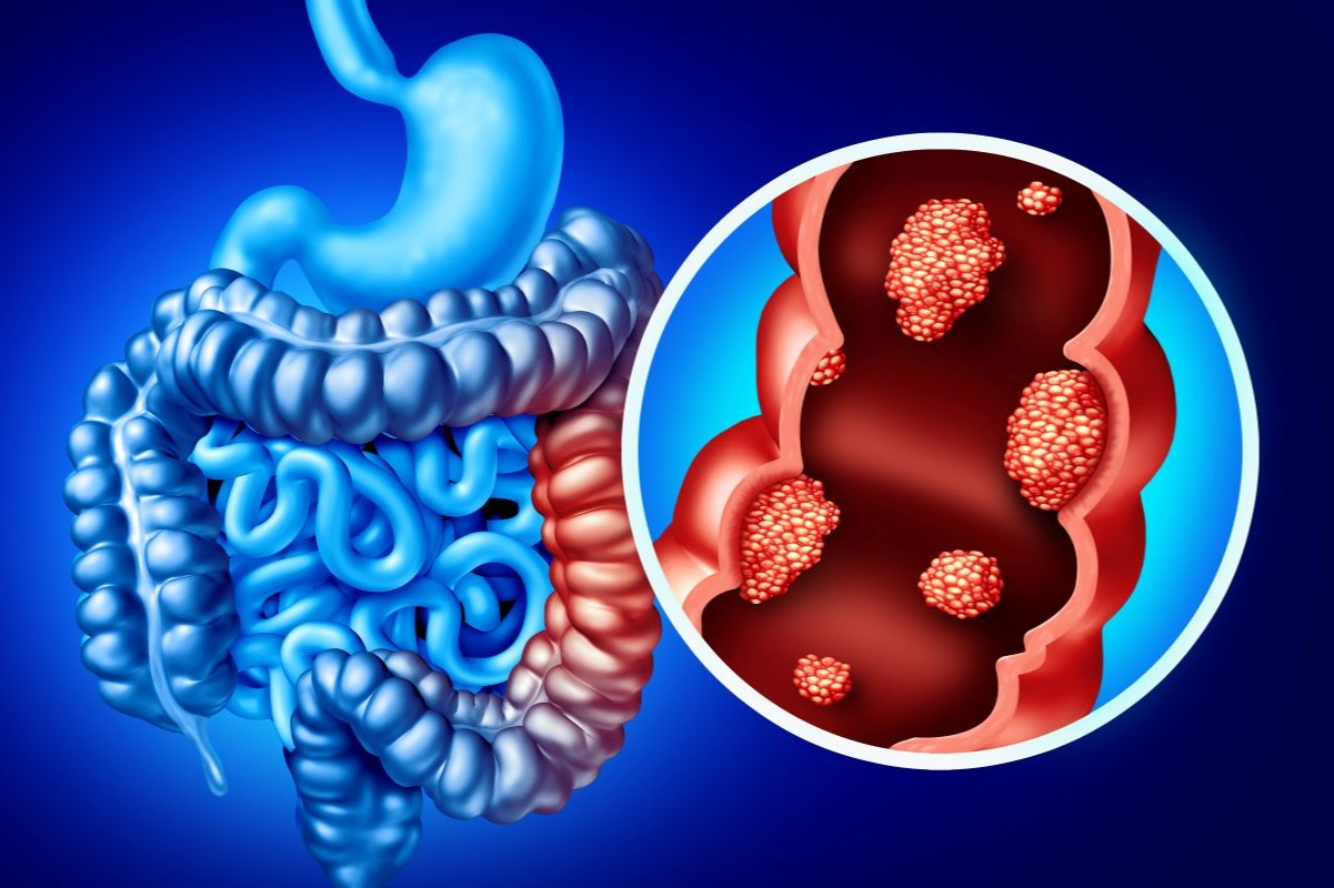 polipi del colon retto sintomi