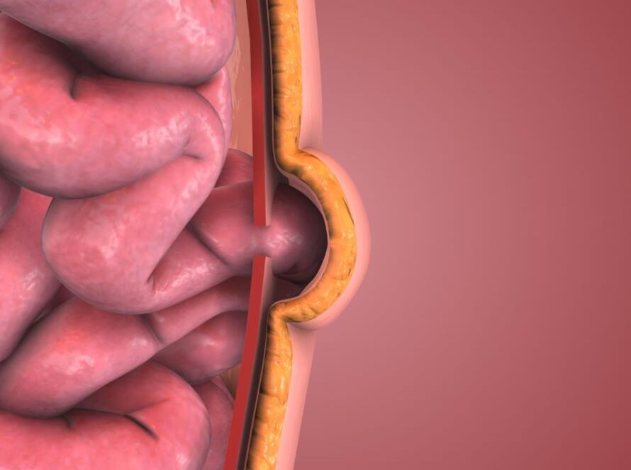 ernia ombelicale sintomi