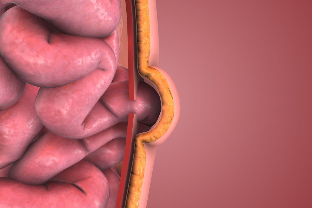 ernia ombelicale sintomi