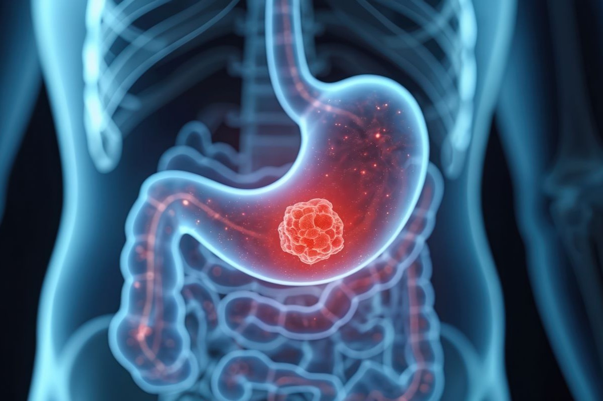 primi sintomi tumore stomaco