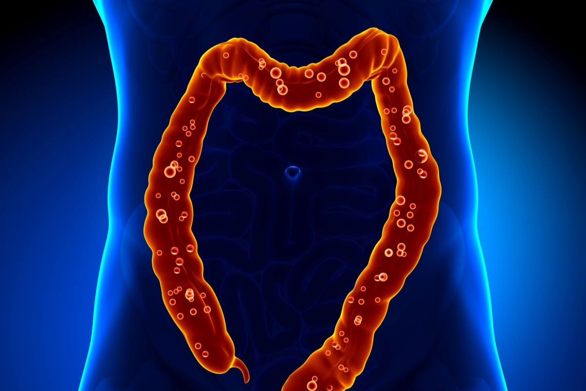 differenza tra diverticolite e diverticolosi
