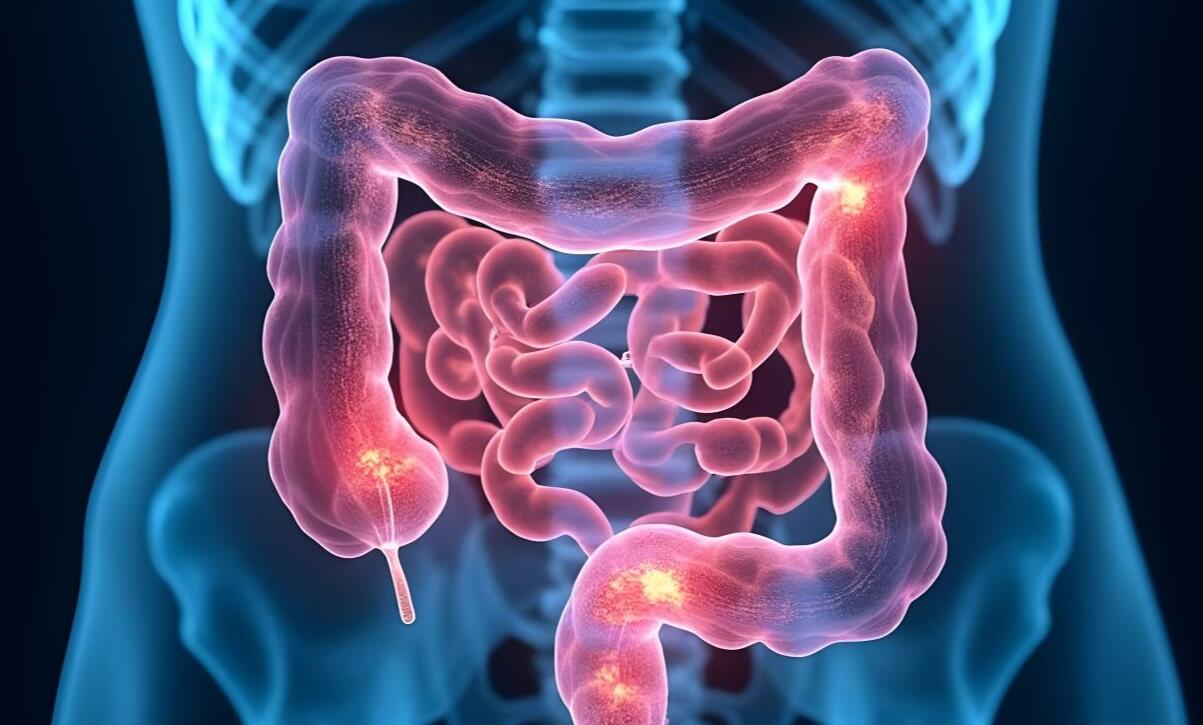 perforazione intestinale cause