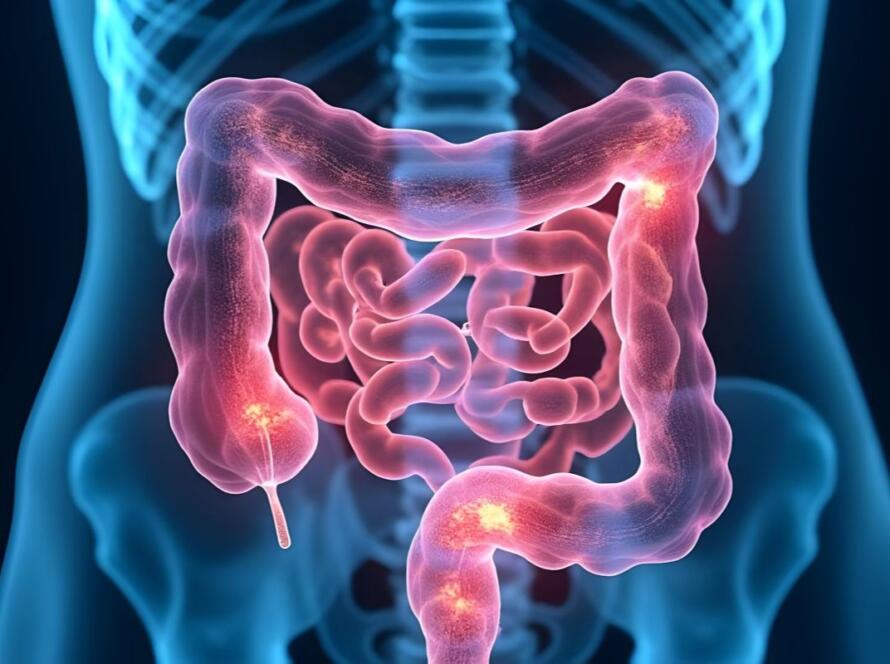 perforazione intestinale cause