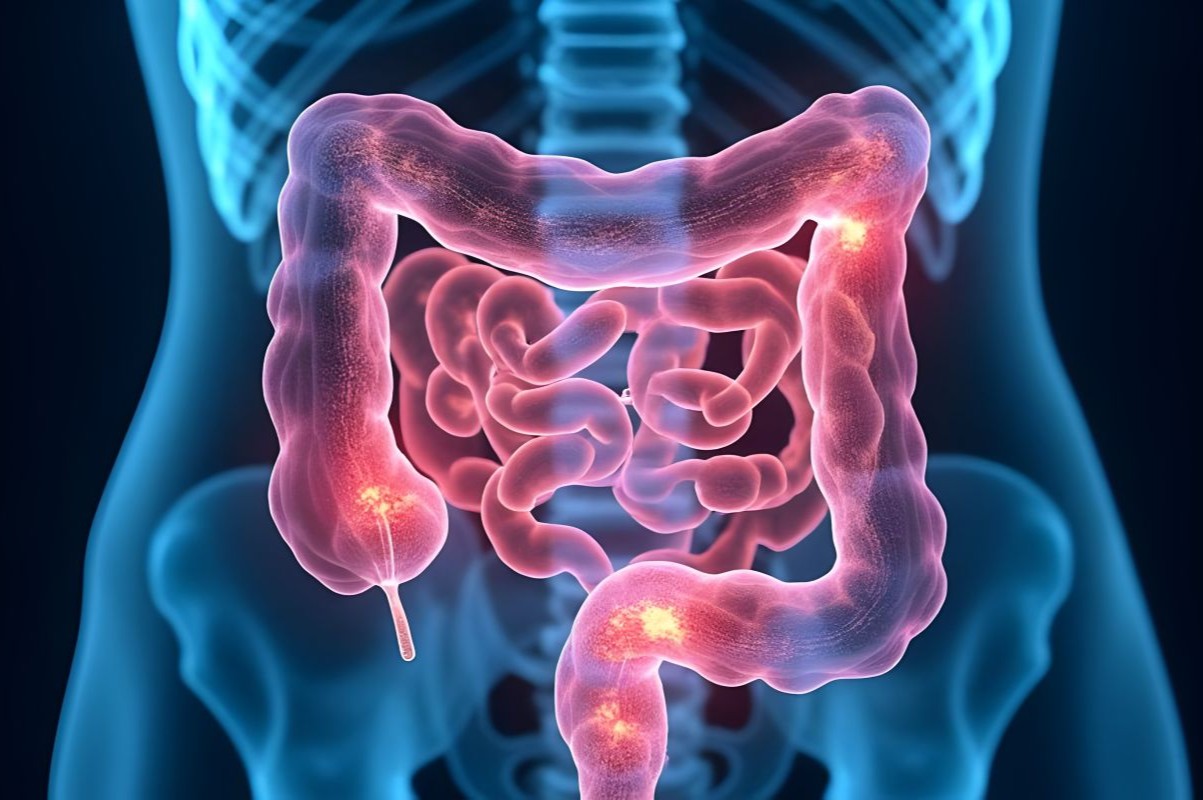 perforazione intestinale cause