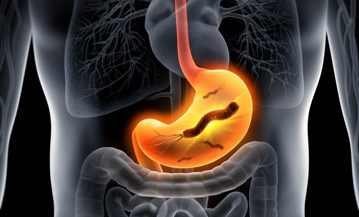 helicobacter pylori tumore