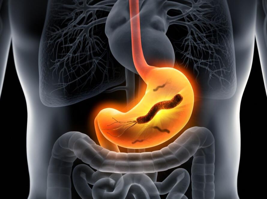 helicobacter pylori tumore