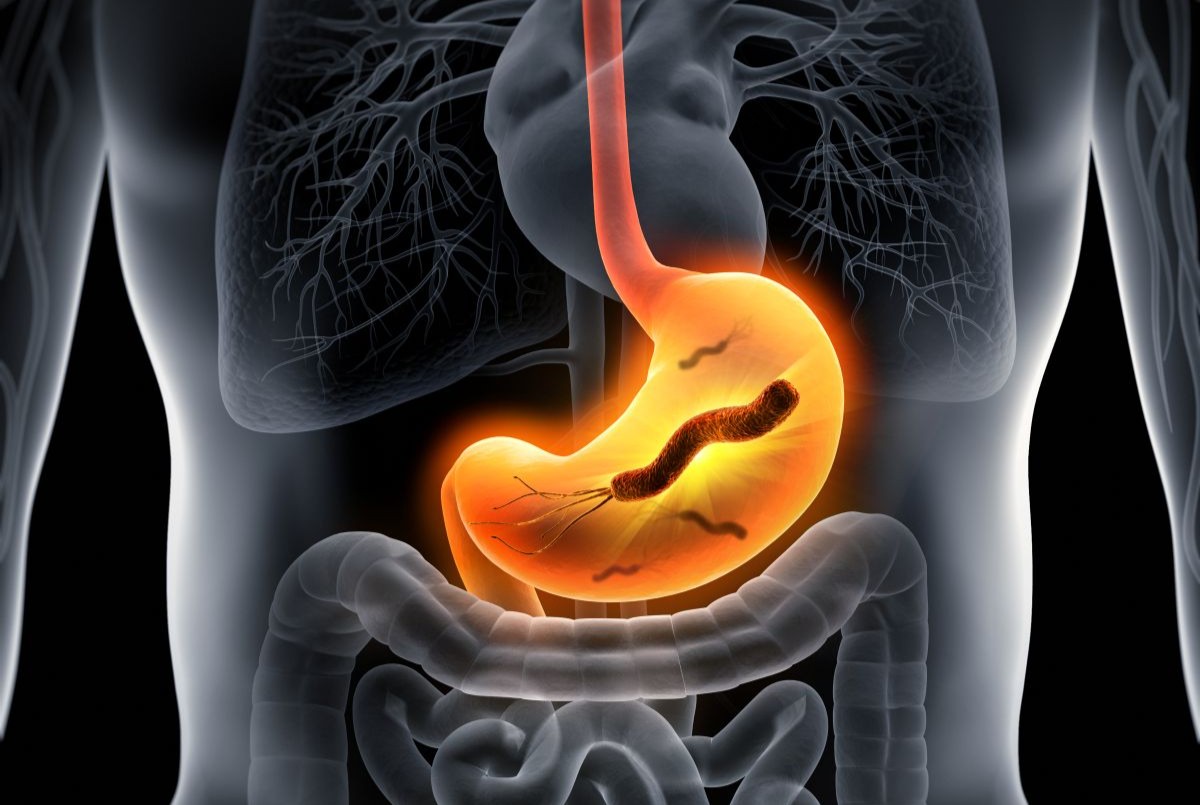 helicobacter pylori tumore
